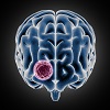 World Brain Tumor Day